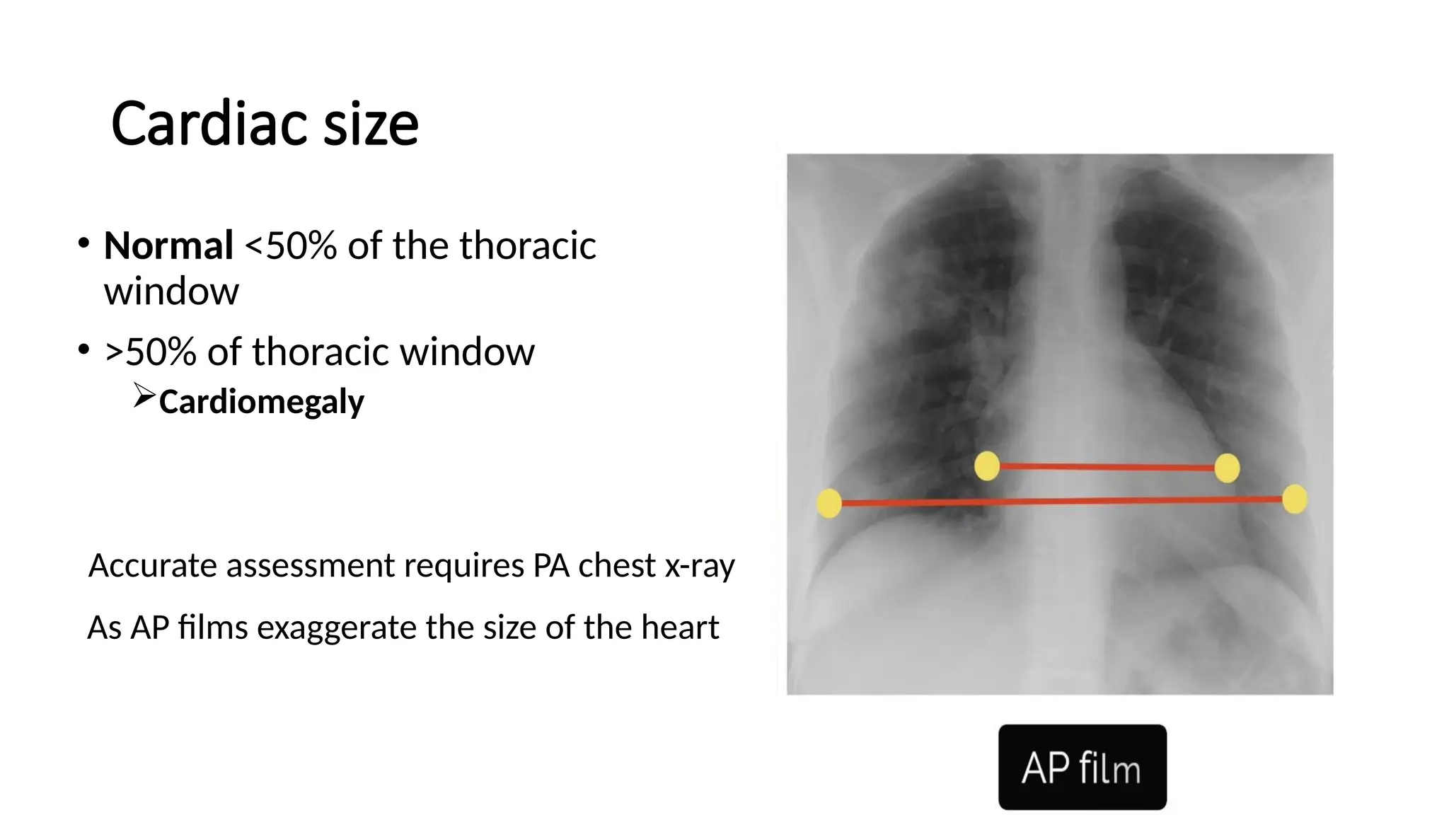 Cardiac size
• Normal <50% of the thoracic
window
• >50% of thoracic window
Cardiomegaly
Accurate assessment requires PA chest x-ray
As AP films exaggerate the size of the heart
 