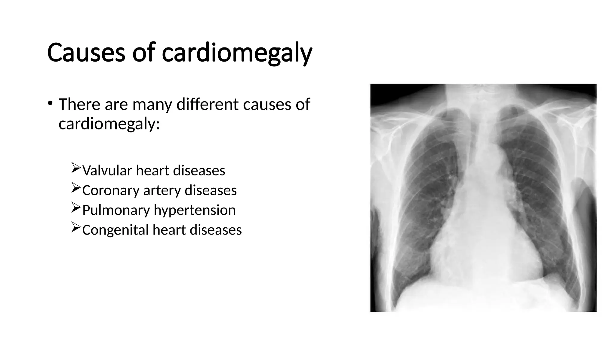 Causes of cardiomegaly
• There are many different causes of
cardiomegaly:
Valvular heart diseases
Coronary artery diseases
Pulmonary hypertension
Congenital heart diseases
 