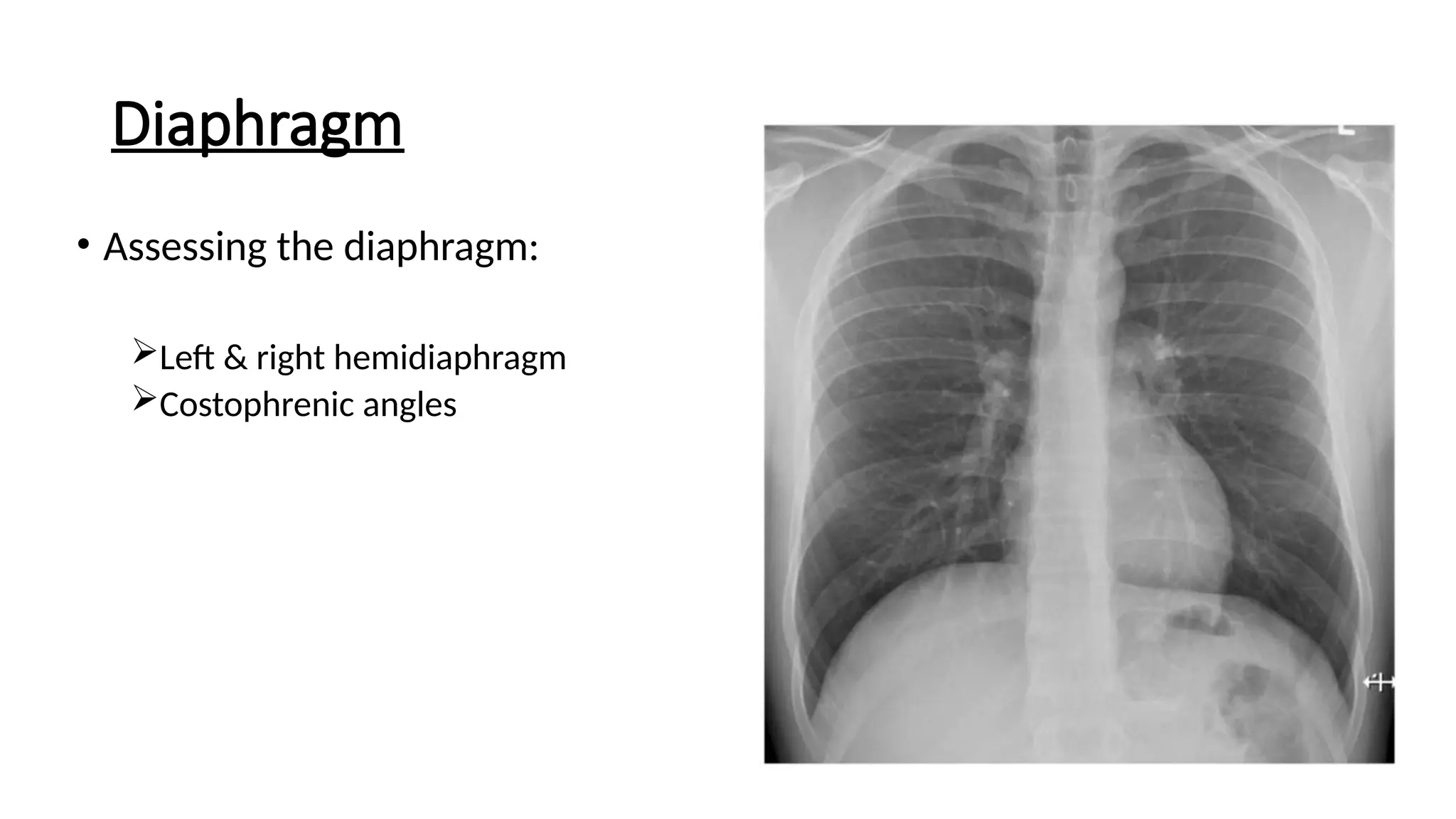 Diaphragm
• Assessing the diaphragm:
Left & right hemidiaphragm
Costophrenic angles
 