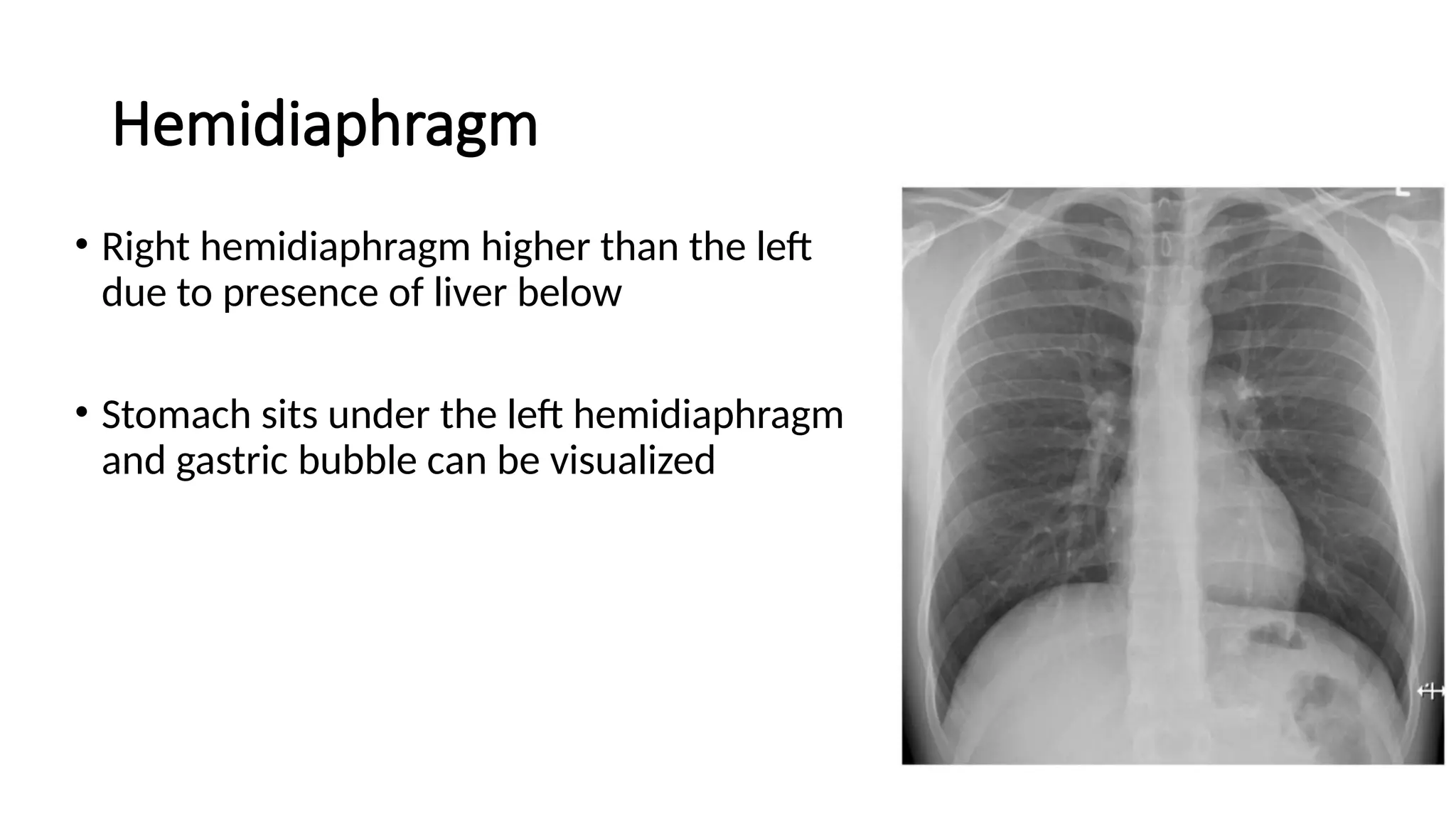 Hemidiaphragm
• Right hemidiaphragm higher than the left
due to presence of liver below
• Stomach sits under the left hemidiaphragm
and gastric bubble can be visualized
 