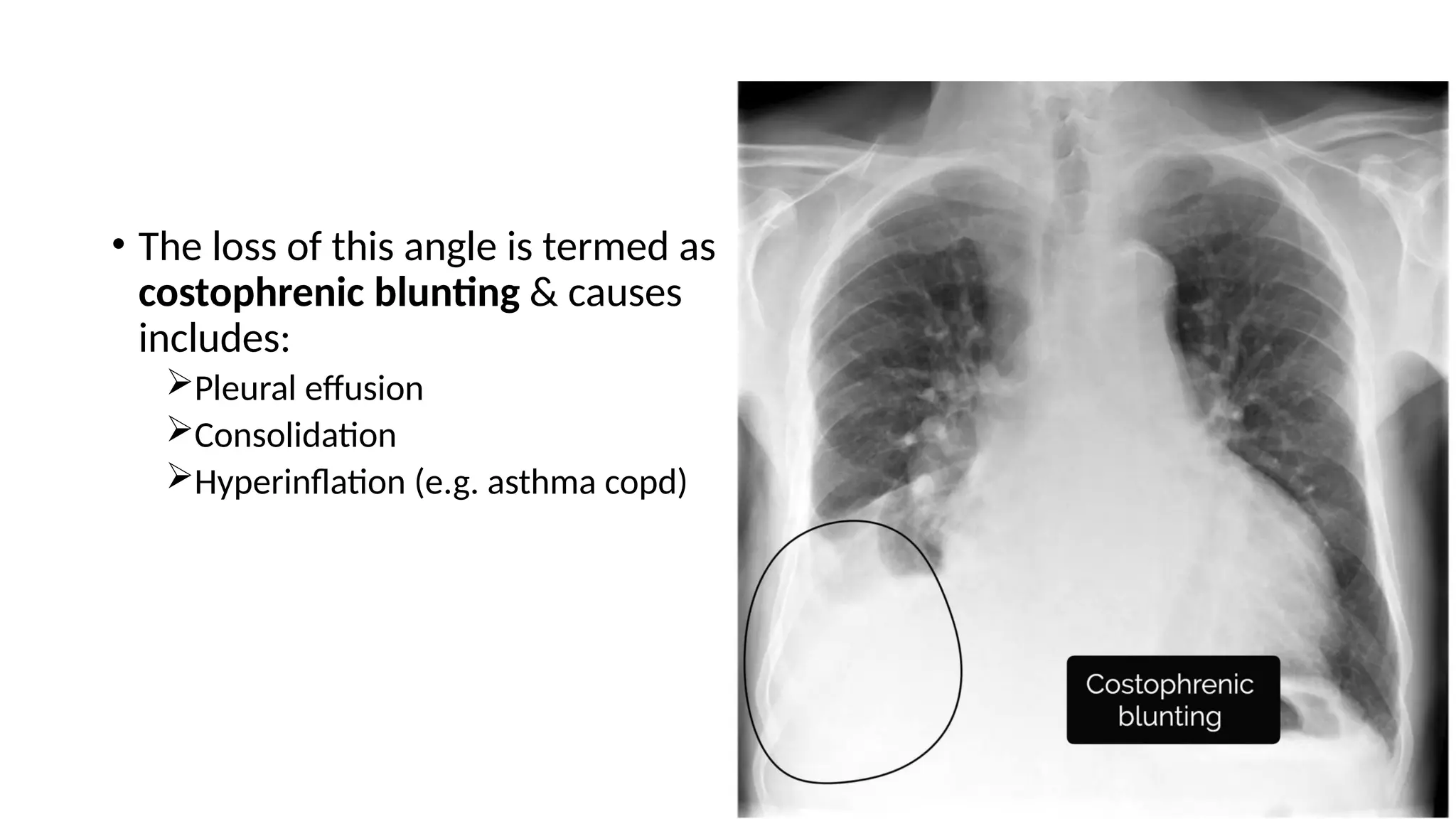 • The loss of this angle is termed as
costophrenic blunting & causes
includes:
Pleural effusion
Consolidation
Hyperinflation (e.g. asthma copd)
 