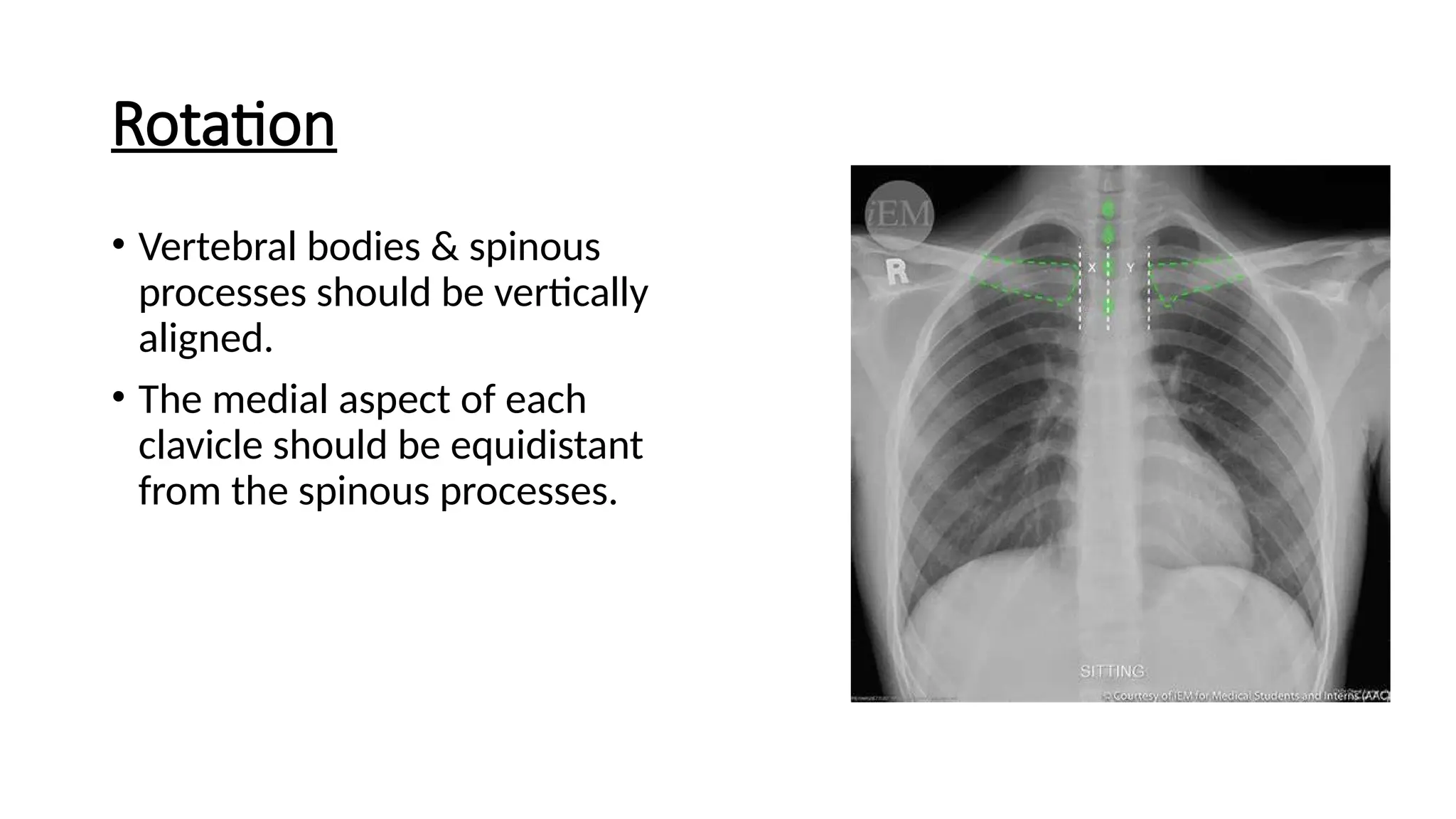 Rotation
• Vertebral bodies & spinous
processes should be vertically
aligned.
• The medial aspect of each
clavicle should be equidistant
from the spinous processes.
 