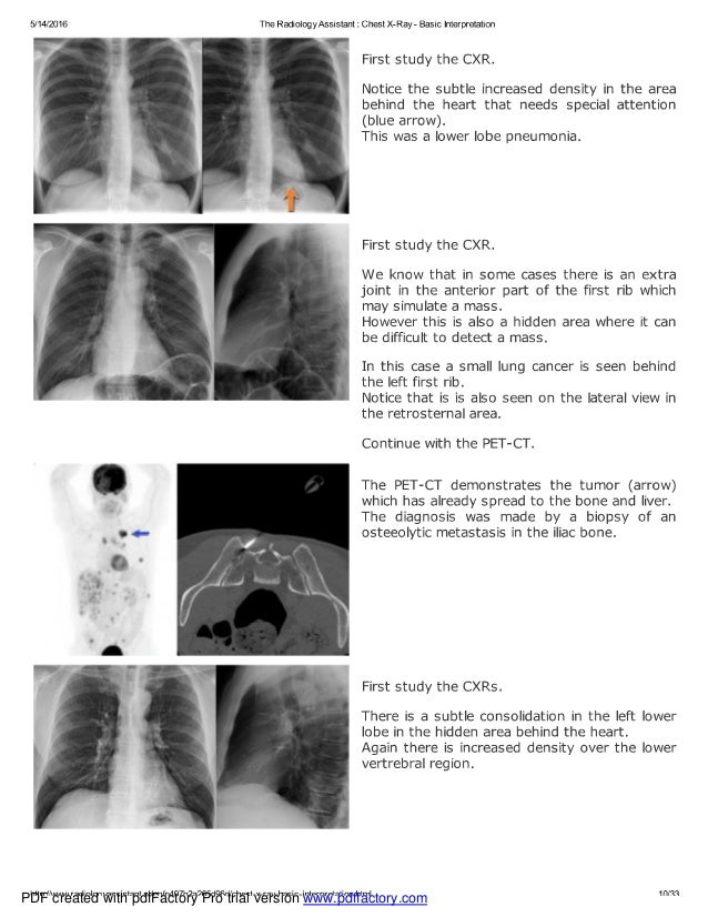 Chest x ray basic interpretation