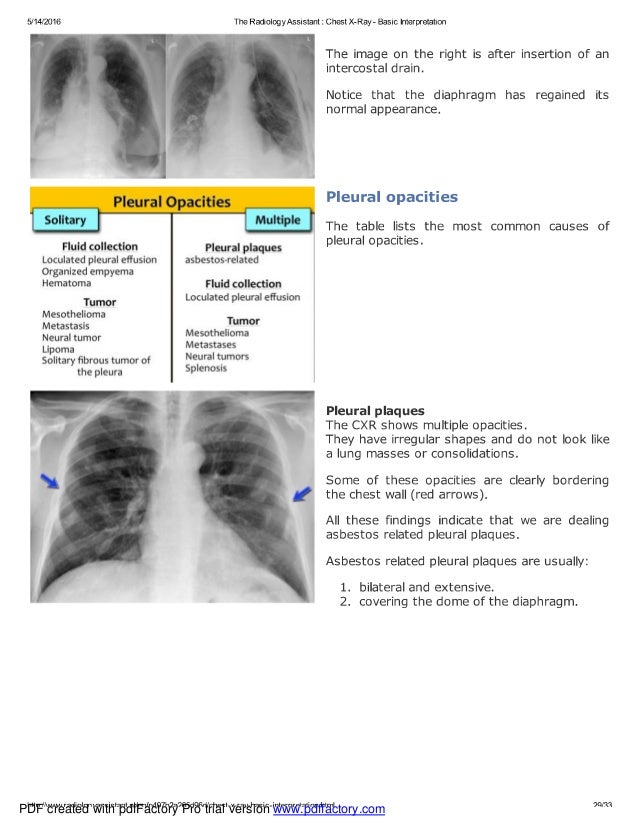 Chest x ray basic interpretation