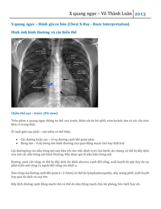 X quang ngực – Võ Thành Luân 2013
X quang ngực – Đánh giá cơ bản (Chest X-Ray - Basic Interpretation)
Hình ảnh bình thường và các biến thể
Chiều thế sau – trước (PA view)
Trên phim x quang ngực thẳng tư thế sau trước, khảo sát từ bờ phổi, vòm hoành, tim và các cấu trúc
khác ở trung thất.
Ở ranh giới của phổi – mô mềm có thể thấy:
 Các đường hoặc sọc – ví vụ đường cạnh khí quản phải
 Bóng mờ - ví dụ bóng mờ bình thường của quai động mạch chủ hay thất trái
Các đường hay các dấu bóng mờ này hữu ích cho việc định vị trí của bệnh, do chúng có thể bị đẩy lệch,
xóa mờ các dấu bóng mờ bình thường. Đây được gọi là dấu hiệu bóng mờ.
Đường cạnh cột sống có thể bị đẩy lệch do khối abscess cạnh đốt sống, xuất huyết do gãy hay do sự
phát triển mở rộng ra ngoài đốt sống của khối u.
Dãn rộng của đường cạnh khí quản (> 2-3mm) có thể do lymphadenopathy, dày màng phổi, xuất huyết
hay quá tải dịch và suy tim.
Đẩy lệch đường cạnh động mạch chủ có thể do dãn động mạch chủ, túi phòng, bóc tách hay vỡ.
 