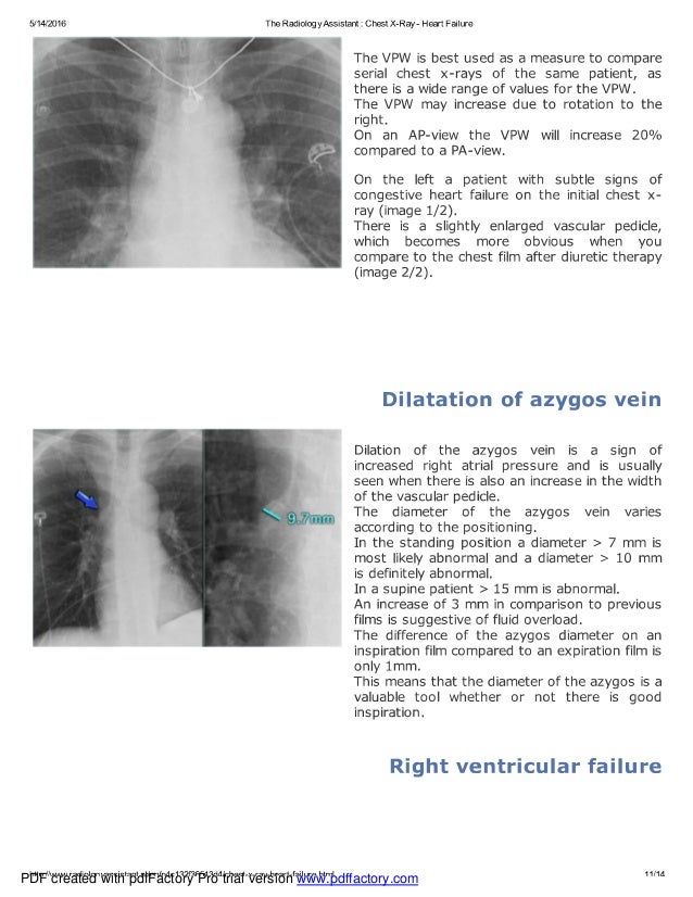 Chest x ray heart failure