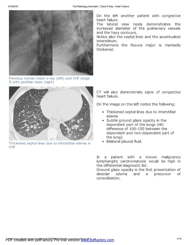 Chest x ray heart failure