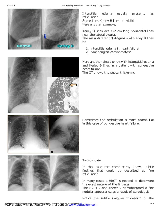 Chest x ray - lung disease | PDF