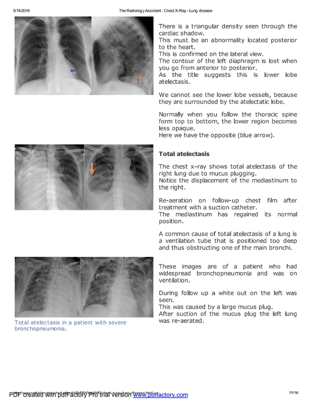 Chest x ray - lung disease | PDF