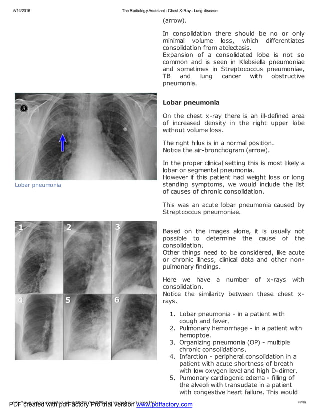 Chest x ray - lung disease | PDF