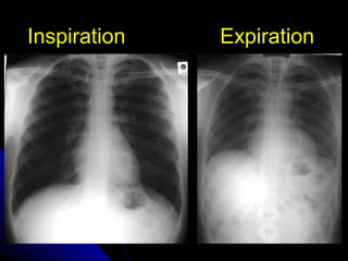 IInnssppiirraattiioonn EExxppiirraattiioonn 
11 
 
