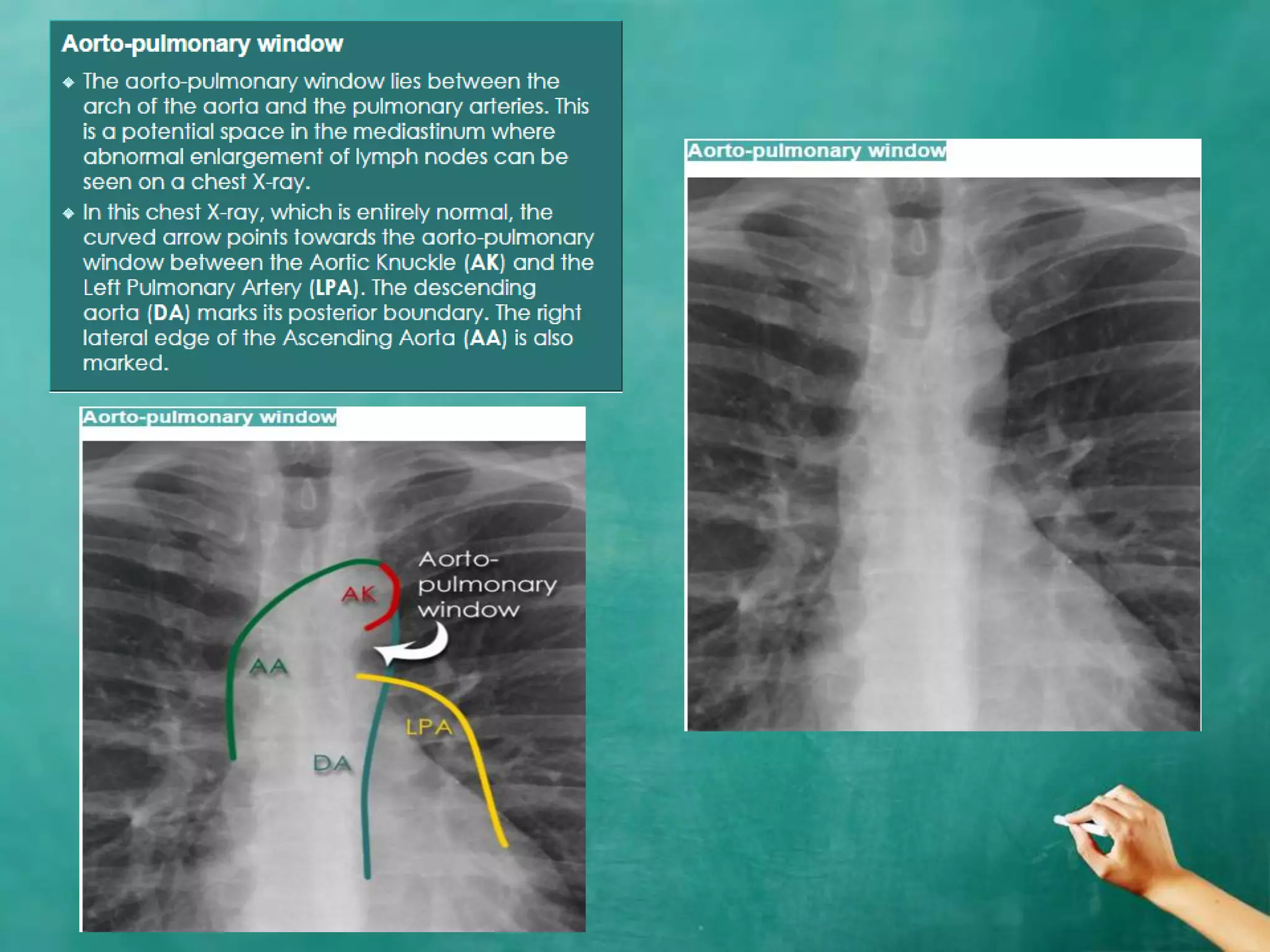 Chest x ray anatomy - how to interpret chest x-ray (2) | PPTX