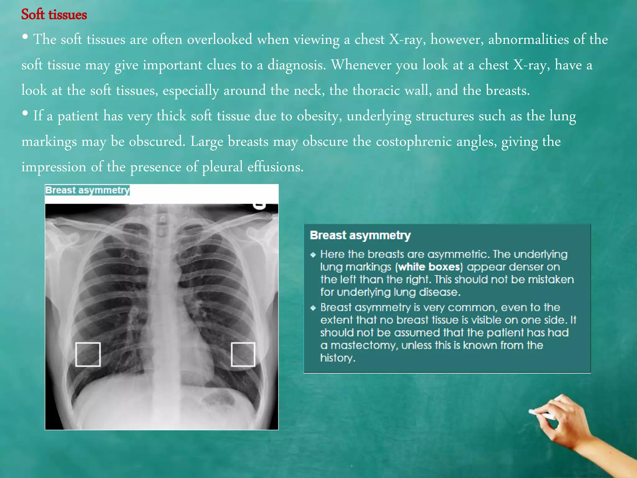 Chest x ray anatomy - how to interpret chest x-ray (2) | PPTX