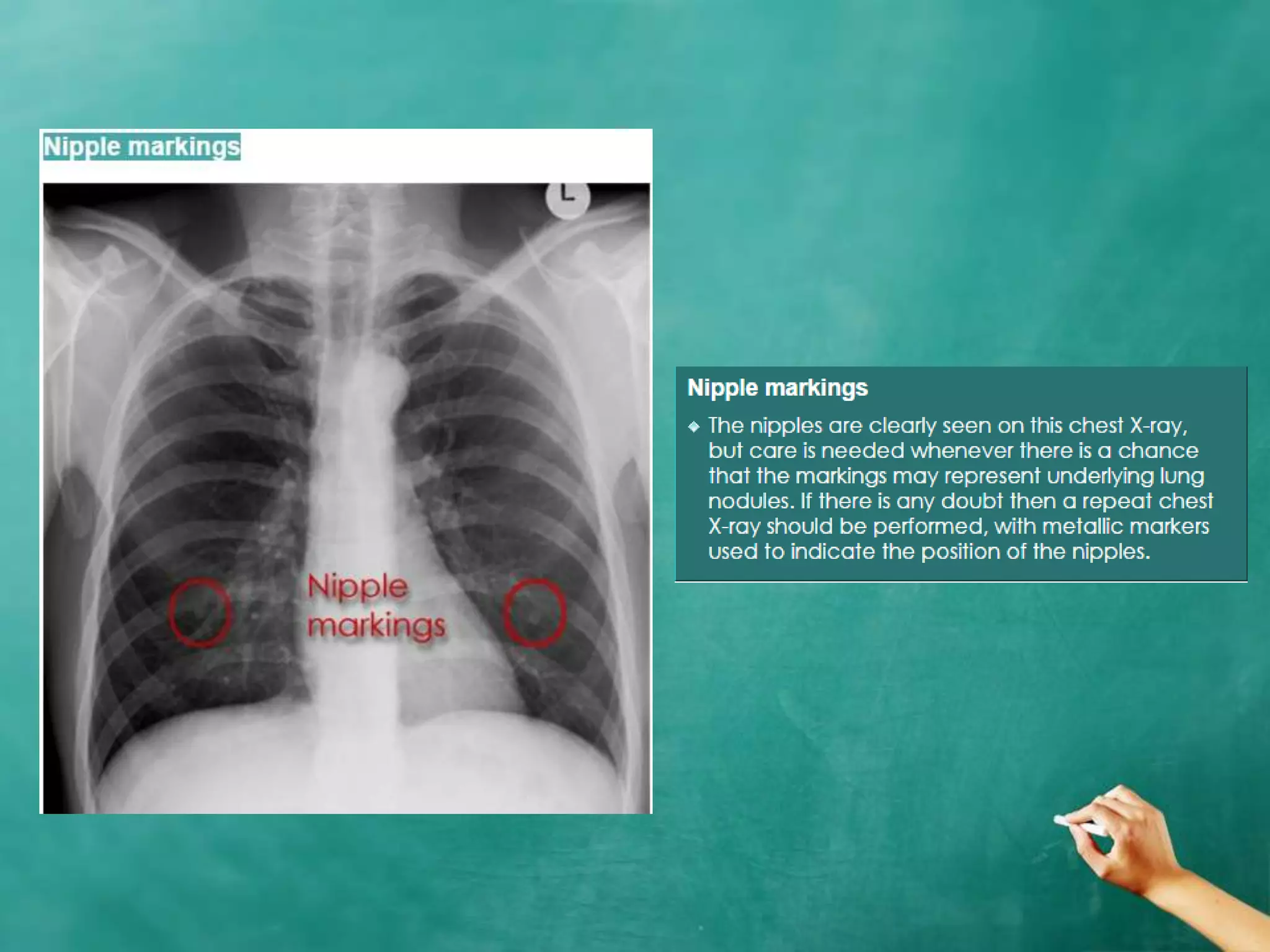 Chest x ray anatomy - how to interpret chest x-ray (2) | PPTX