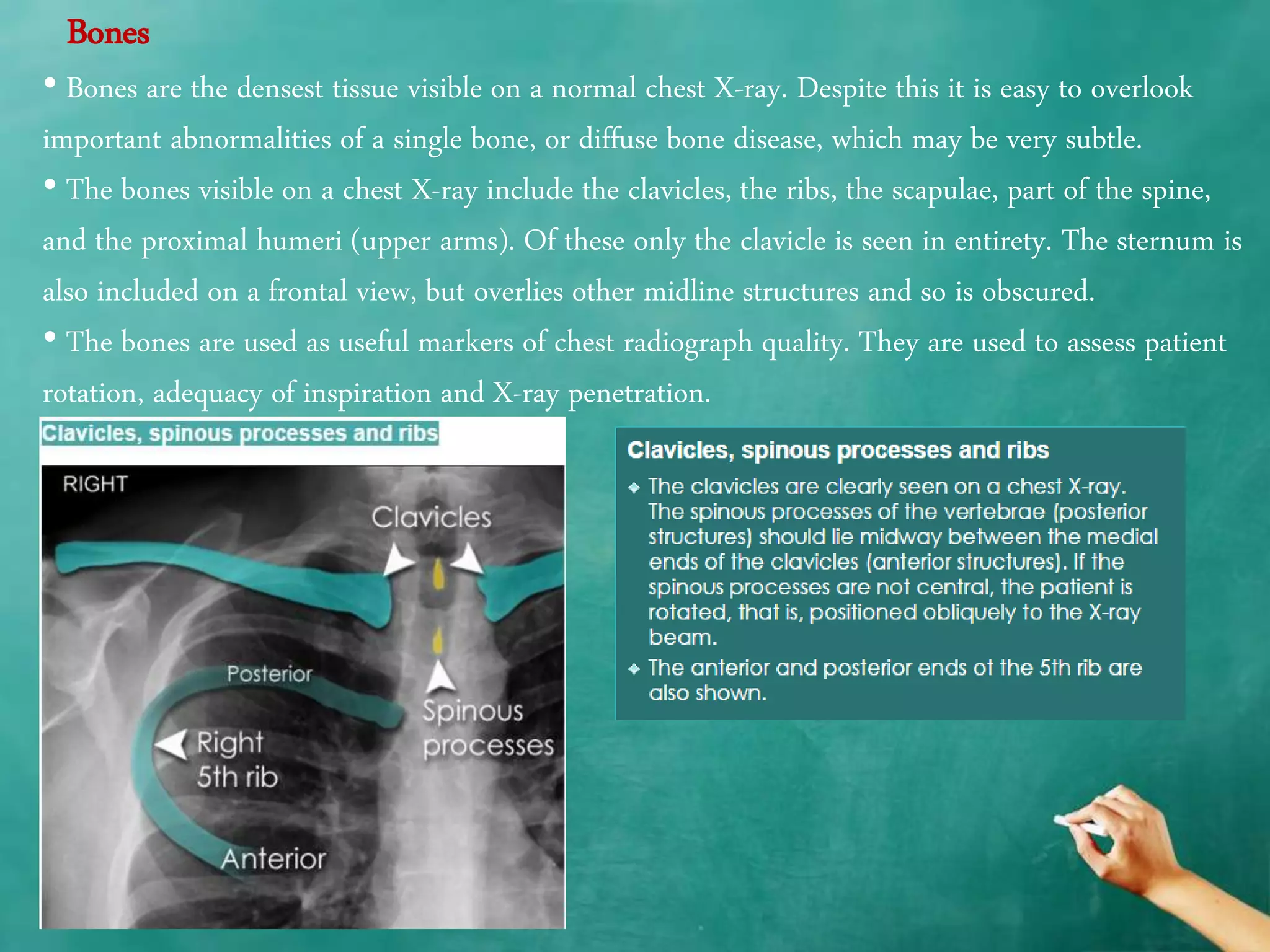 Chest x ray anatomy - how to interpret chest x-ray (2) | PPTX