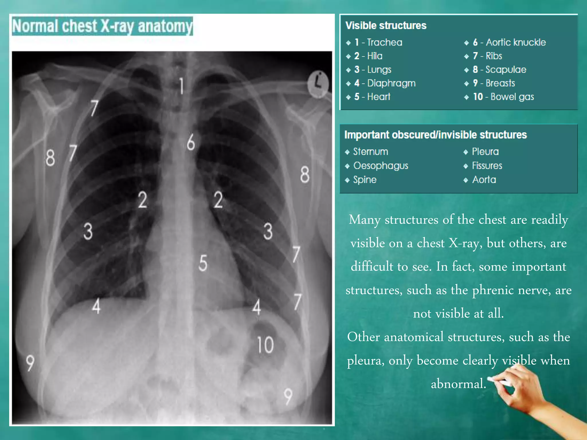 Chest x ray anatomy - how to interpret chest x-ray (2) | PPTX
