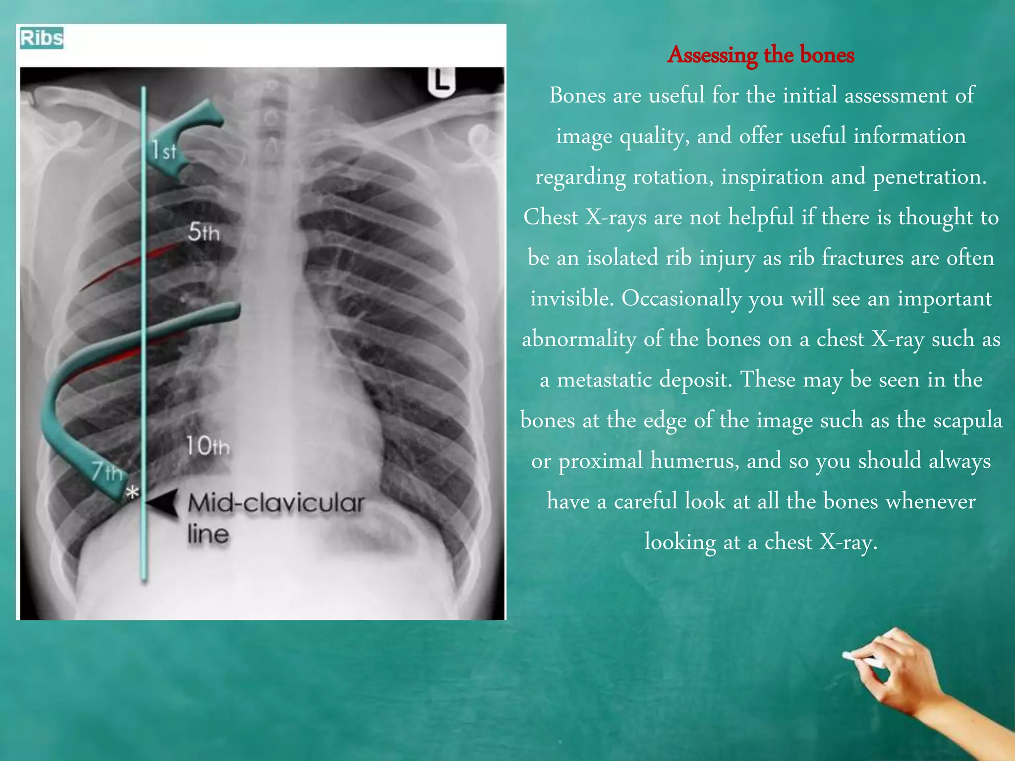 Chest x ray anatomy - how to interpret chest x-ray (2) | PPTX