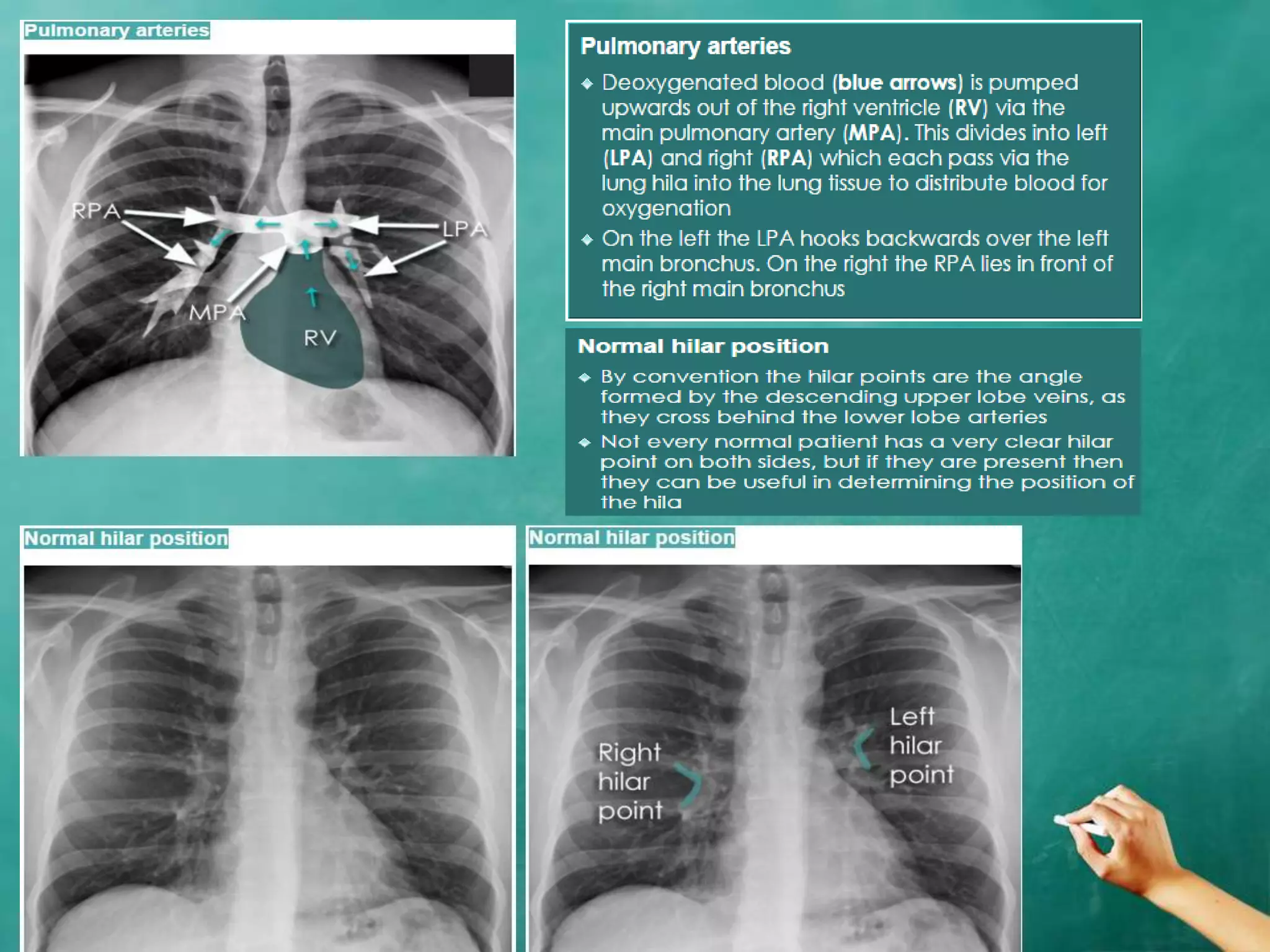 Chest x ray anatomy - how to interpret chest x-ray (2) | PPTX