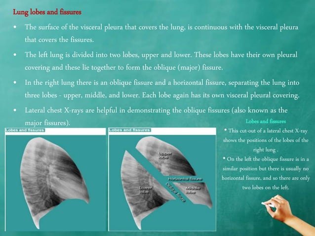 Chest x ray anatomy - how to interpret chest x-ray (2) | PPTX