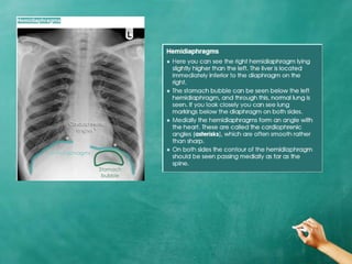 Chest x ray anatomy - how to interpret chest x-ray (2) | PPTX