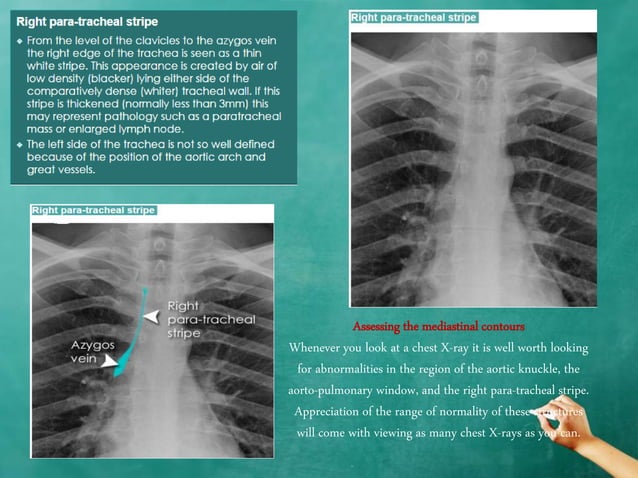 Chest x ray anatomy - how to interpret chest x-ray (2) | PPTX