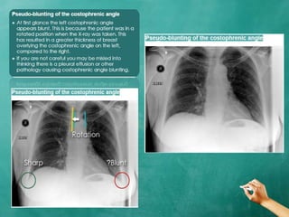 Chest x ray anatomy - how to interpret chest x-ray (2) | PPTX