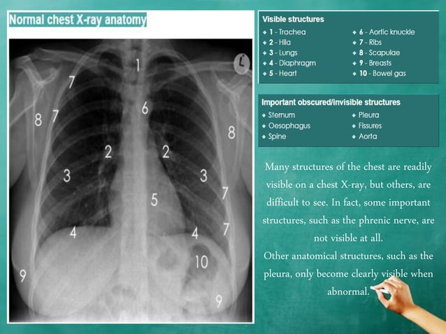 Chest x ray anatomy - how to interpret chest x-ray (2) | PPTX