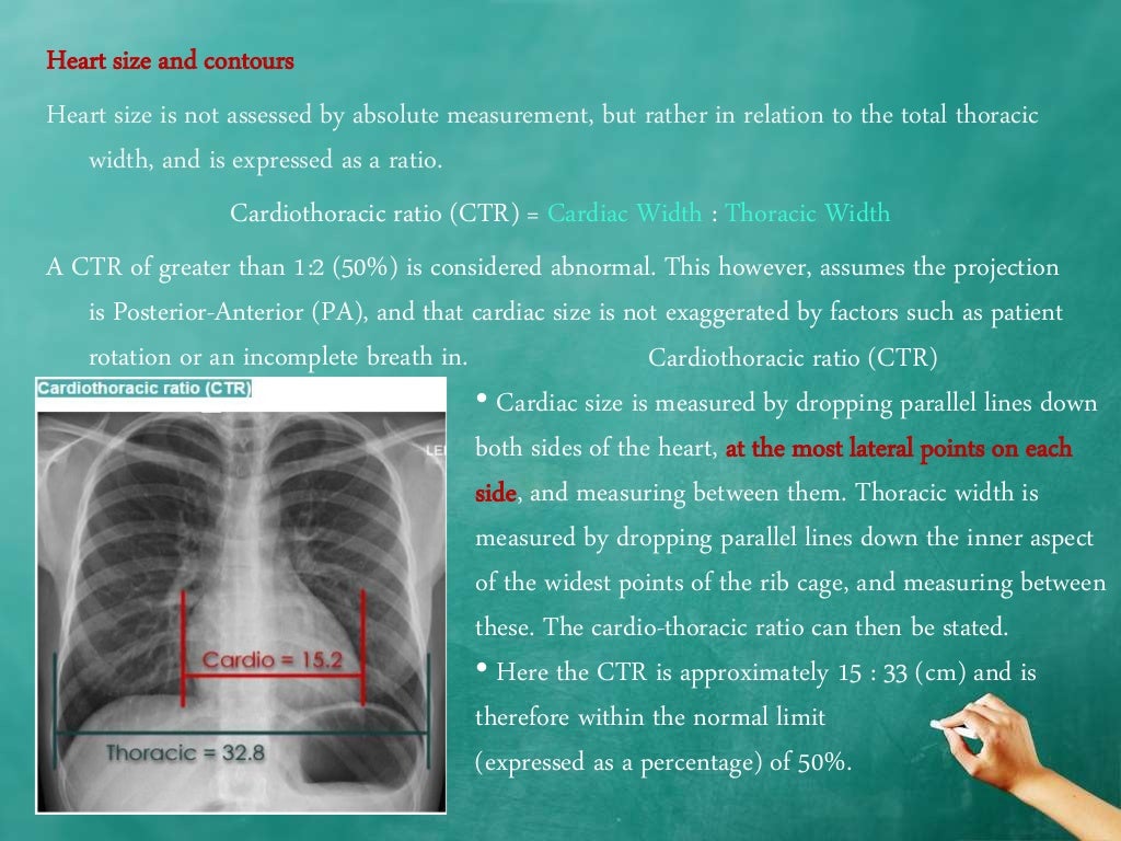 Chest x ray anatomy how to interpret chest xray (2)