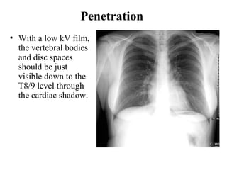 Chest x ray and other imaging investigations of chest by dr bishnu | PDF