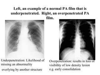 Chest x ray and other imaging investigations of chest by dr bishnu | PDF