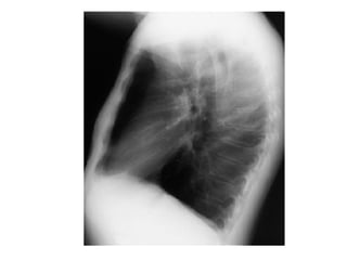 Chest x ray and other imaging investigations of chest by dr bishnu | PDF