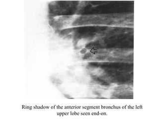 Chest x ray and other imaging investigations of chest by dr bishnu | PDF