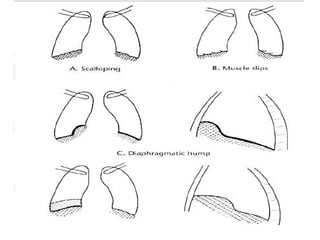 Chest x ray and other imaging investigations of chest by dr bishnu | PDF