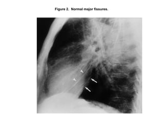 Chest x ray and other imaging investigations of chest by dr bishnu | PDF