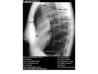 Chest x ray and other imaging investigations of chest by dr bishnu | PDF