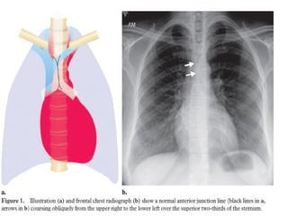 Chest x ray and other imaging investigations of chest by dr bishnu | PDF