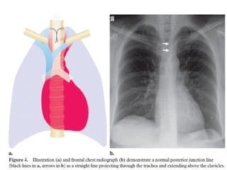 Chest x ray and other imaging investigations of chest by dr bishnu | PDF