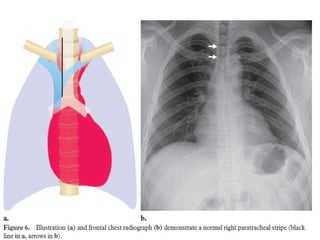 Chest x ray and other imaging investigations of chest by dr bishnu | PDF