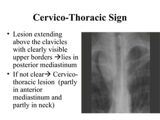 Stuart Sign Cervical Chest x ray and other imaging investigations of chest by dr bishnu | PDF