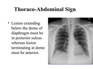 Chest x ray and other imaging investigations of chest by dr bishnu | PDF