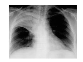 Chest x ray and other imaging investigations of chest by dr bishnu | PDF
