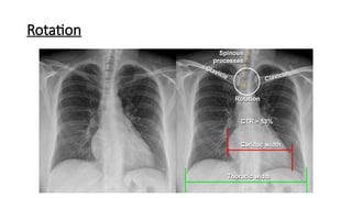 Thoracic S Line Rotation CHEST X-RAY, art of diagnosis.pptx SA SA S S S | PPTX