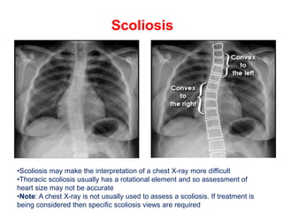 Scoliosis
•Scoliosis may make the interpretation of a chest X-ray more difficult
•Thoracic scoliosis usually has a rotational element and so assessment of
heart size may not be accurate
•Note: A chest X-ray is not usually used to assess a scoliosis. If treatment is
being considered then specific scoliosis views are required
 