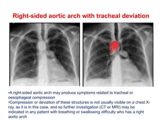 Right-sided aortic arch with tracheal deviation
•A right-sided aortic arch may produce symptoms related to tracheal or
oesophageal compression
•Compression or deviation of these structures is not usually visible on a chest X-
ray, as it is in this case, and so further investigation (CT or MRI) may be
indicated in any patient with breathing or swallowing difficulty who has a right
aortic arch
 