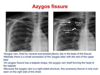 Azygos fissure
•Azygos vein, lined by visceral and parietal pleura, lies in the base of the fissure
•Medially there is a small connection of the 'azygos lobe' with the rest of the upper
lobe
•An azygos fissure has a tadpole shape, the azygos vein itself forming the head of
the tadpole
•Because the azygos vein is a right-sided structure, this accessory fissure is only ever
seen on the right side of the chest
 