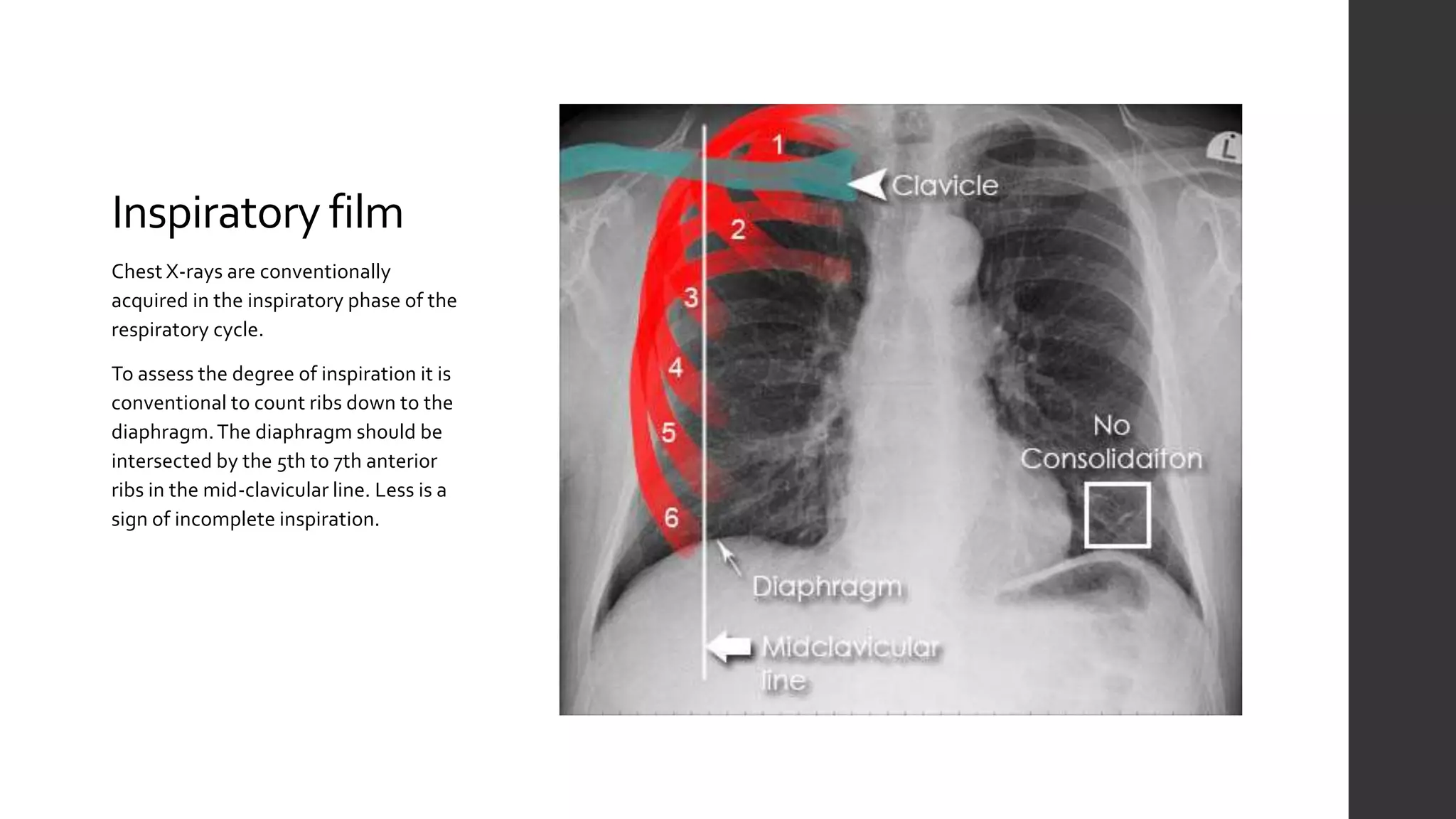 Chest X-ray: The Basics | PPTX