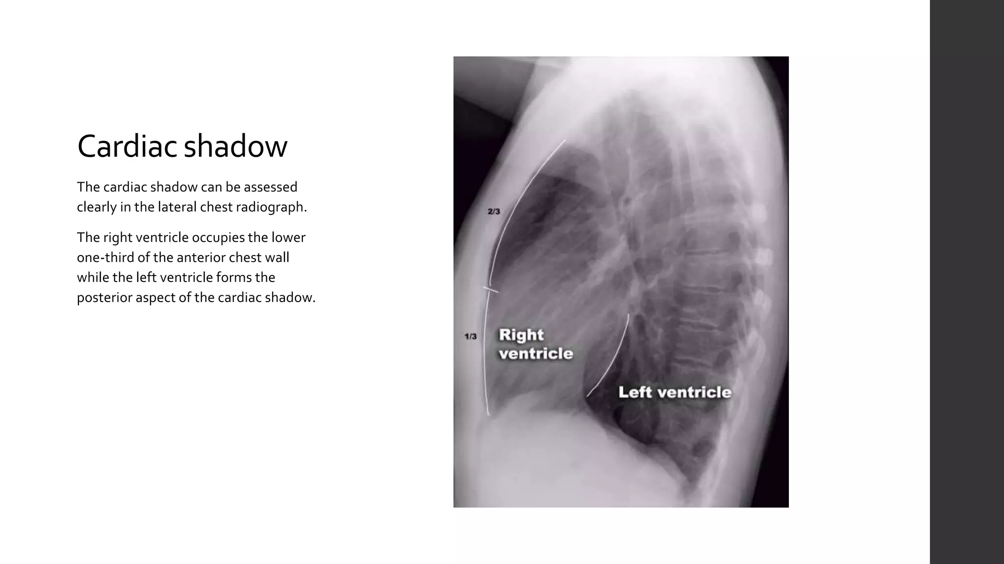 Aortic Shadow Chest X-ray: The Basics | PPTX
