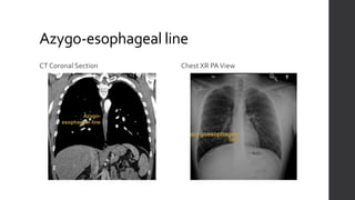 Chest X-ray: The Basics | PPTX