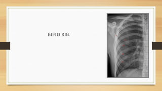 Chest X-ray basics approach, alveolar vs interstitial disease ...
