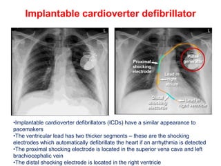 Distal Pacemaker CHEST X-RAY CARDIAC DISEASE.........pptx